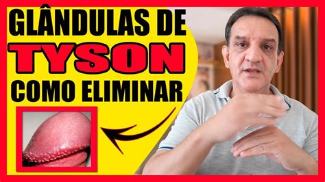 que son las glandulas tyson|Glándulas de Tyson o pápulas perladas